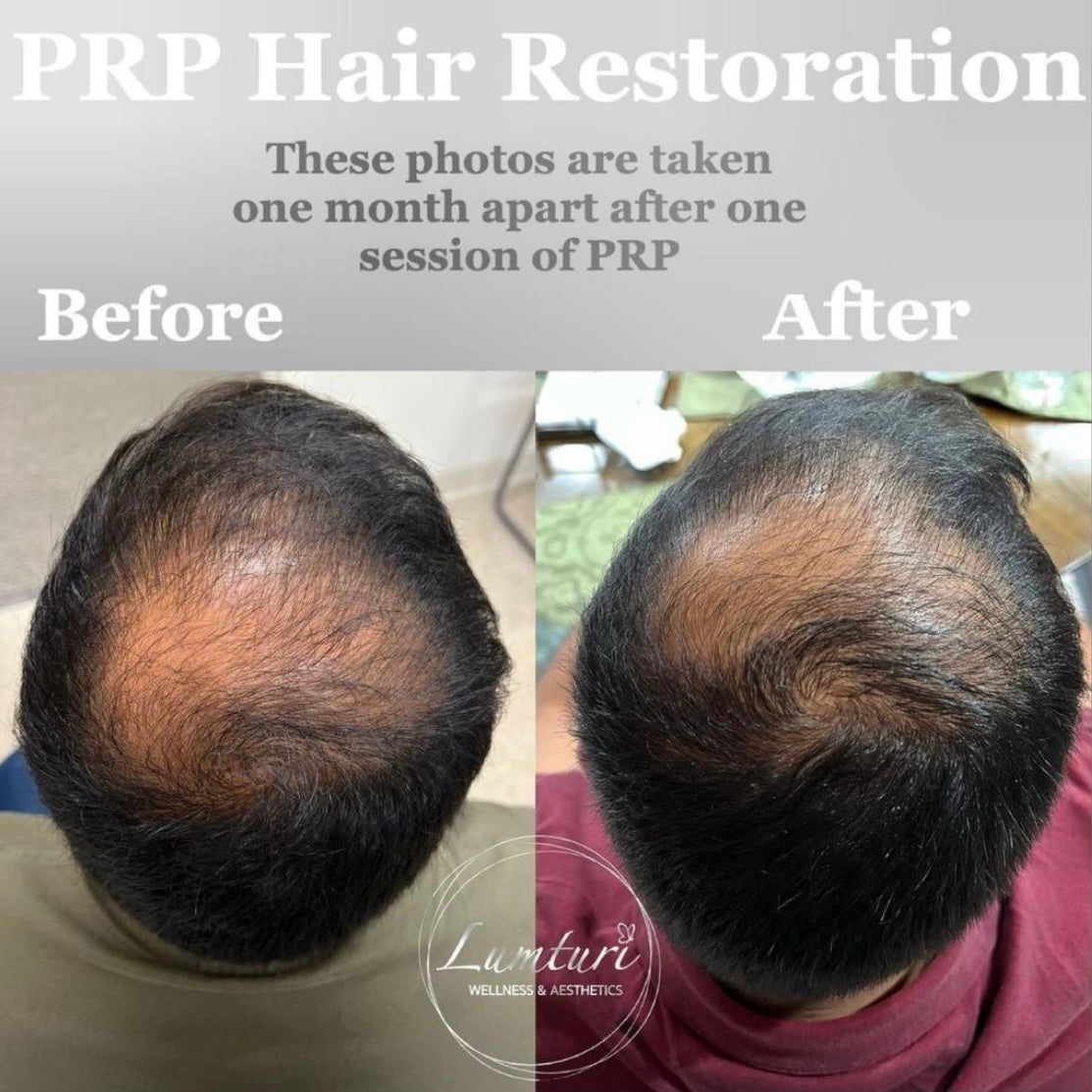 PRP Hair Restoration