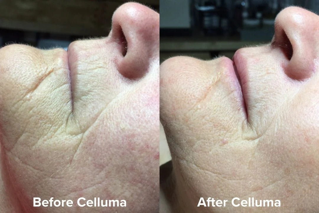 Celluma LED Therapy 6 Pack