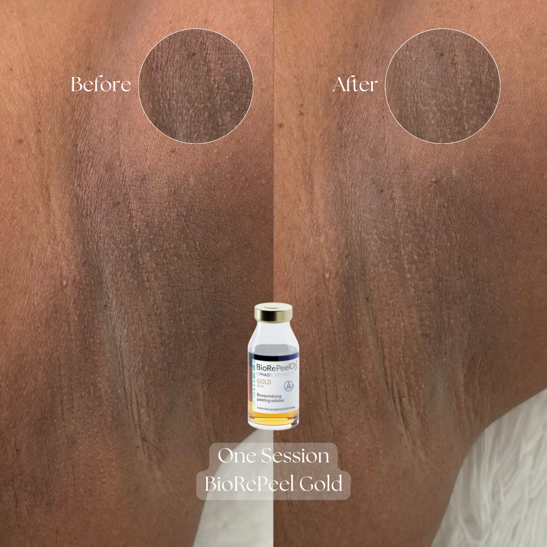 BioRePeel GOLD - Body Treatment